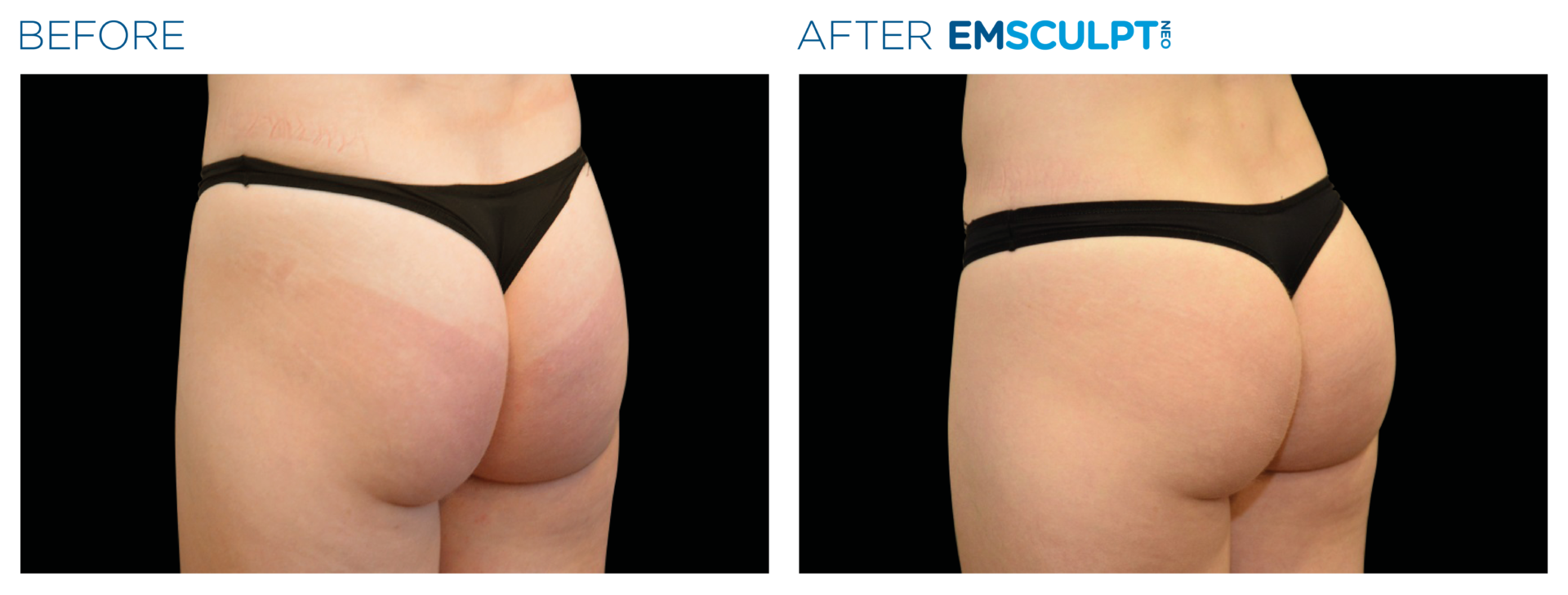 Body Contouring - Emsculpt NEO and Cellutone