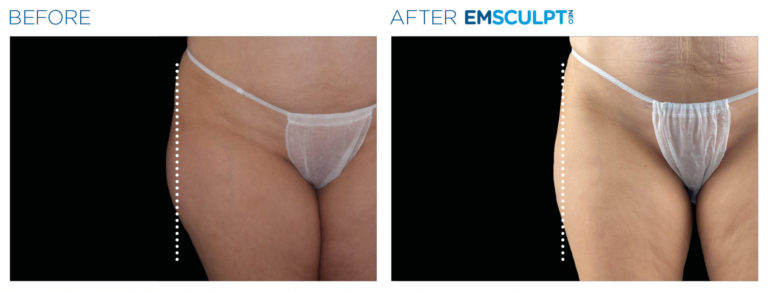 Body Contouring - Emsculpt NEO and Cellutone