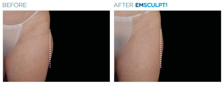 Body Contouring - Emsculpt NEO and Cellutone