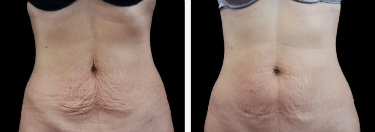 EMTONE ABDOMEN B AND A