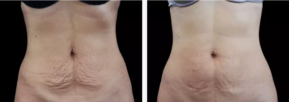 Body Contouring - Emsculpt NEO and Cellutone