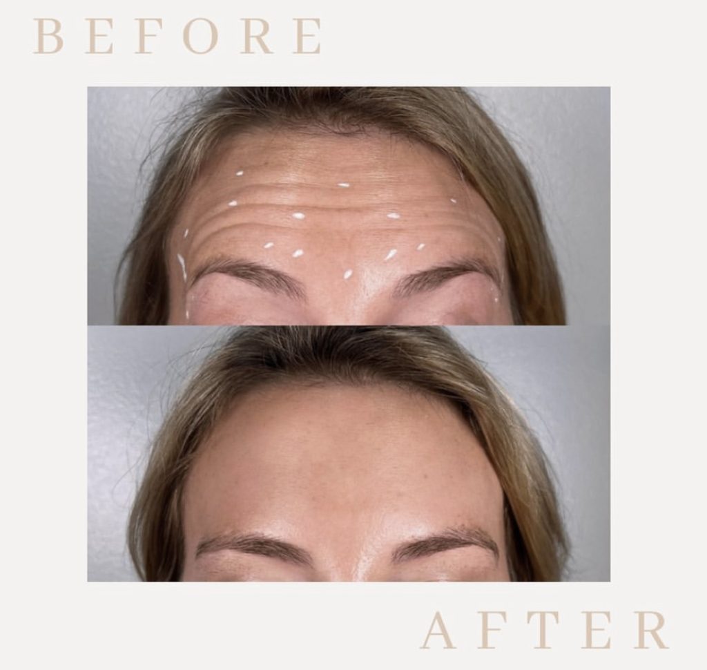 botox austin specials
