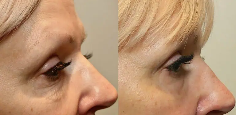 Morpheus8_Before&After (14)
