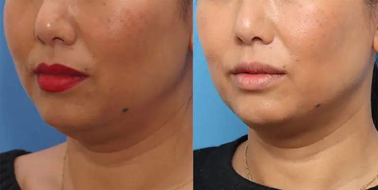 Morpheus8_Before&After (16)