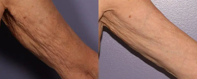 morphues8-before-after-dr-g-stevens-preview-1 (2)